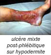 ulcère mixte post-phlébitique sur hypodermite 
