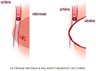 La nécrose des tissus a lieu avant l'apparition de l'ulcère