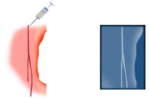 Injection dans une artère pour artériographie