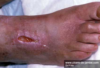 ulcère sur dos du pied