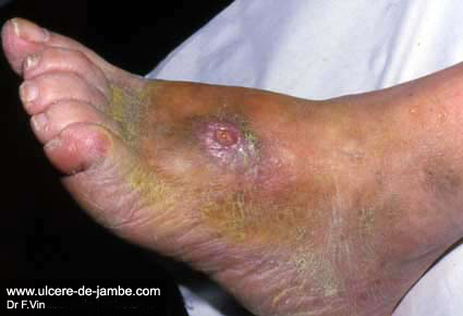ulcère sur dos du pied