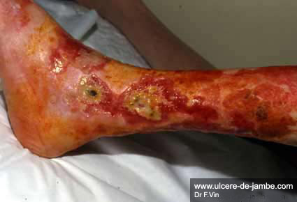 Ulcere jambe amputation